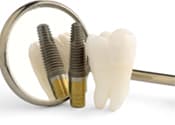 dental implants Murfreesboro