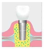 DENTAL IMPLANTS IN MURFREESBORO