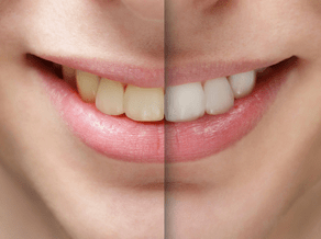 TEETH WHITENING PROCEDURES