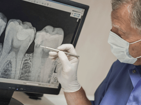 Why Are Root Canal Surgery is so Important in Murfreesboro?