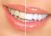Teeth Whitening in Murfreesboro: What You Need to Know to Have a Brighter Smile