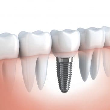 Are Dental Implants Worth It? Here Are 5 Reasons to Say Yes! – Murfreesboro, TN