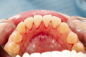 Gum Disease: Common Symptoms and Causes That Everyone Must Know